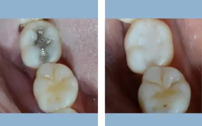 Before and After